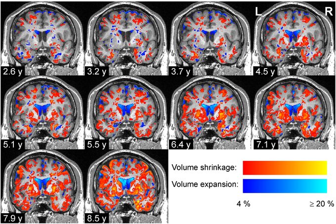 MR images showing progressive degeneration of brain tissue in a Parkinson’s disease patient. Image adapted from Pieperhoff et al. 2022 .