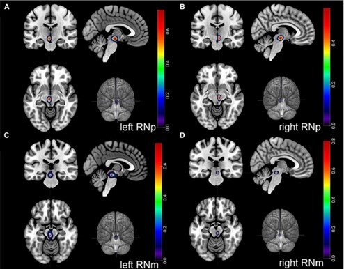 The figure shows the location and the probabilistic maps of the two different subdivisions of the red nucleus (RNp and RNm) in the human brain. The colors in each voxel indicate the probability of the structure being present there based on the variability in 10 human subjects.